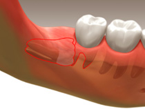 extractions