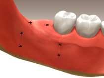 extractions