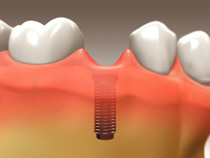 implant_restoration