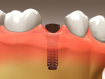 implant_restoration