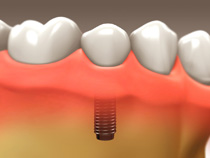 implant_restoration