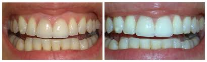 non surgical gum therapy