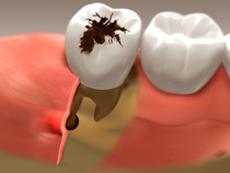 root_canal