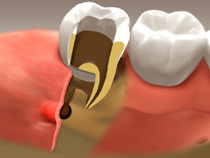 root_canal