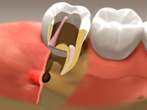 root_canal