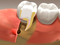 root_canal