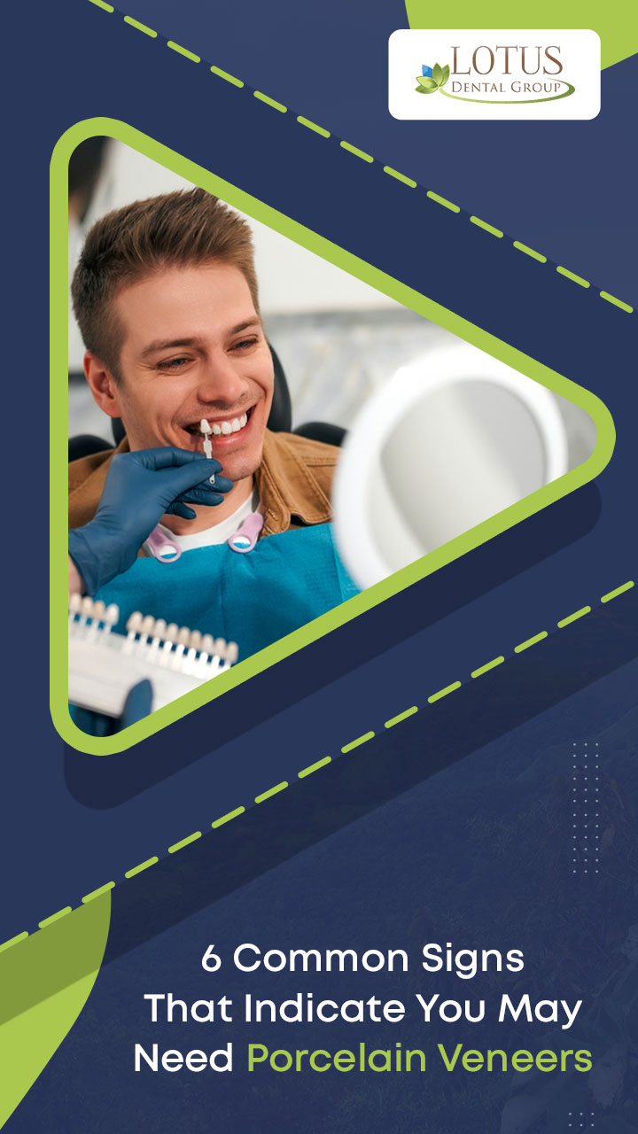 6 Common Signs That Indicate You May Need Porcelain Veneers
