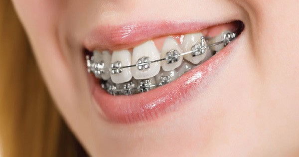 Braces (Orthodontia)