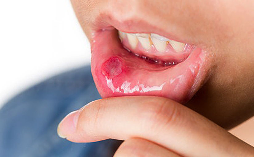 Canker/Cold Sores