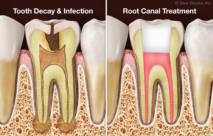 Tooth Decay & Root Canal