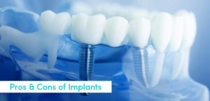 Dental Implants: Pros and cons