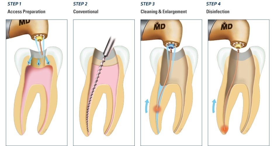 The Warning Signs that you need a root canal treatment