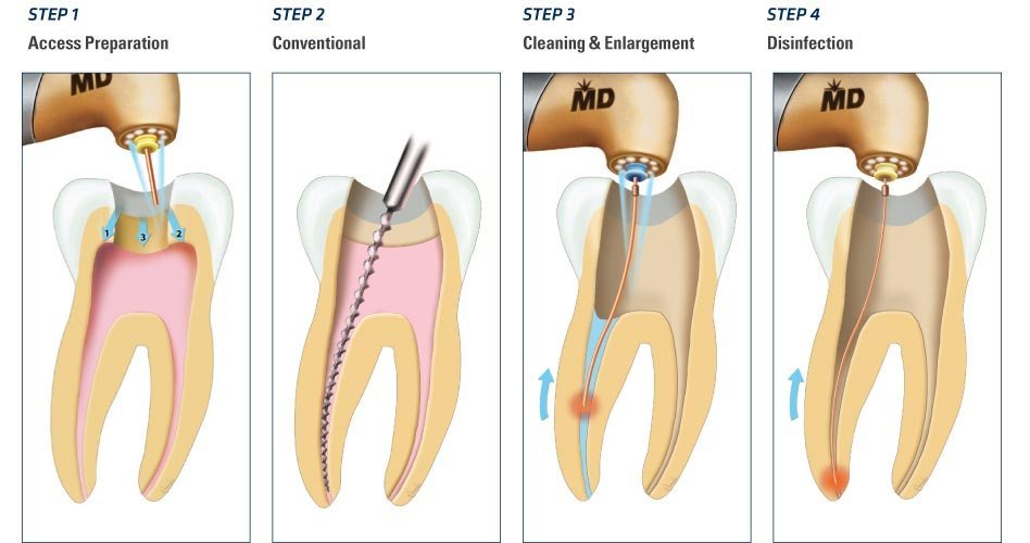 Root Canal Symptoms – Signs of Needing a Root Canal?