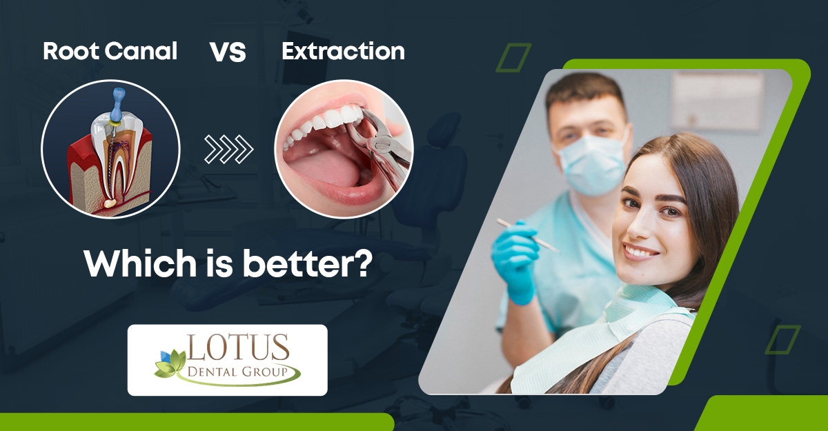 Root Canal vs Extraction – Which is better?